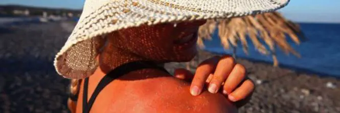 Eritema solare, i rimedi naturali per combatterlo