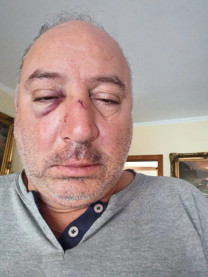 "Pugni e calci, erano in quattro". Aggredito il consigliere leghista