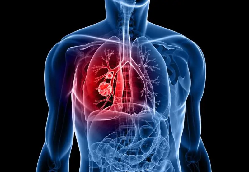 Tumore al polmone, nuova terapia per pazienti con mutazione del gene Egfr