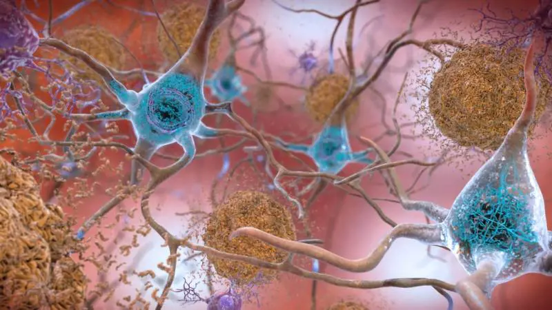 Alzheimer, il litio a piccole dosi potrebbe fermarlo