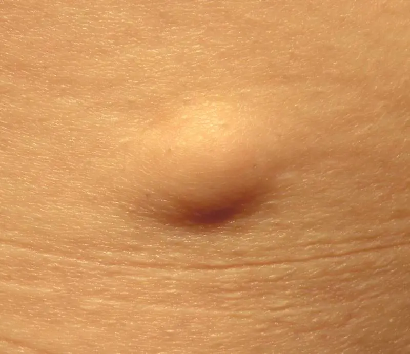 Lipoma, quali sono i sintomi e come si cura