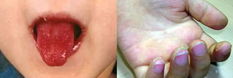 Correlata a Covid c'è una nuova sindrome infiammatoria: attacca i bimbi