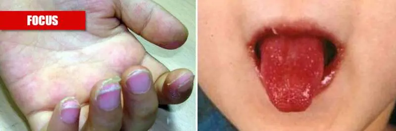 Covid-19 e sindrome di Kawasaki: esiste un legame?