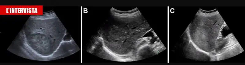 Lesione epatica in crescita