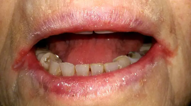 Cheilite angolare, quali sono i sintomi (e cosa fare)