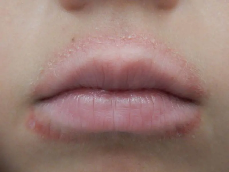 Dermatite periorale: come riconoscerla ​(E cosa fare subito)