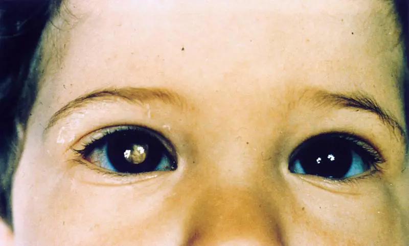 Retinoblastoma, cos'è e quali sono i sintomi