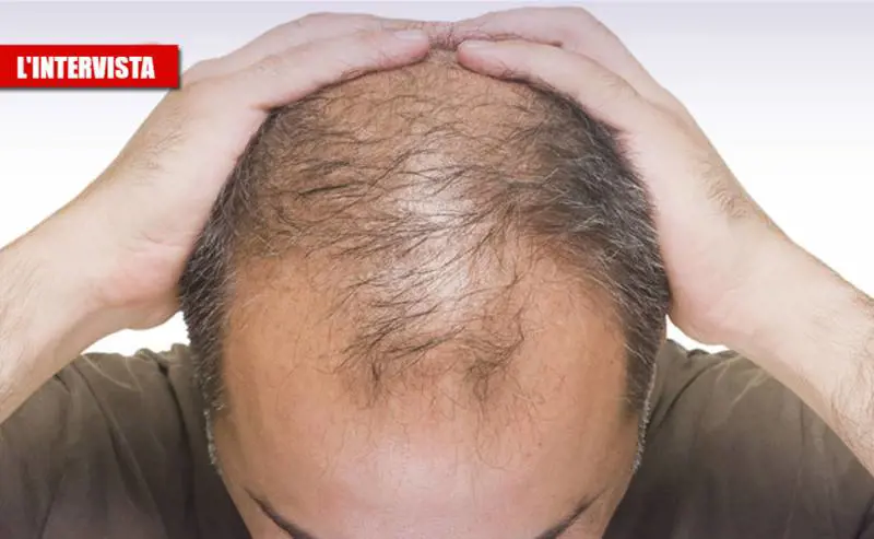 Il virus e il legame coi capelli: "Colpisce di più chi non li ha"