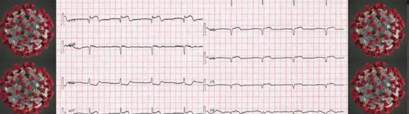 Paura per la sindrome Takotsubo: che cosa accade con il Covid