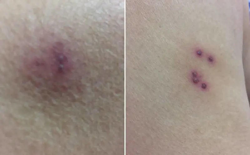 Donna morsa da ragno violino in pineta "Ecco come mi ha ridotta"