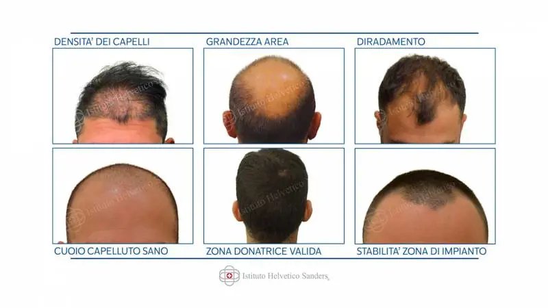 Trapianto di capelli, in Italia è meglio che all'estero?