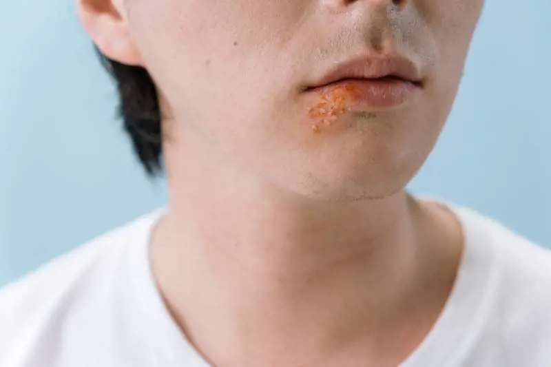 Herpes labiale, i rimedi naturali per trattarlo