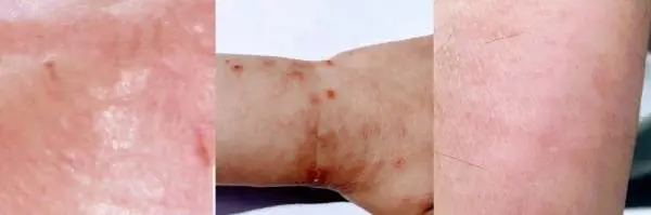 I 6 segni sulla nostra pelle che annunciano il contagio da Covid