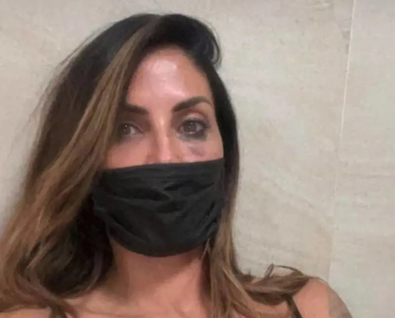 Aggressione a Guendalina Tavassi: "Frattura del naso e contusioni multiple"