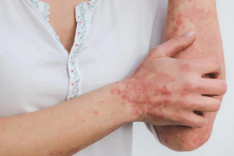 Psoriasi: perché a 60 anni è più frequente e come curarla