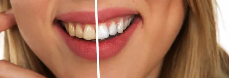 Faccette dentali, il "miracolo" per un sorriso perfetto