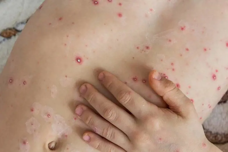 Cos'è "l'influenza del pomodoro" che allarma l'India