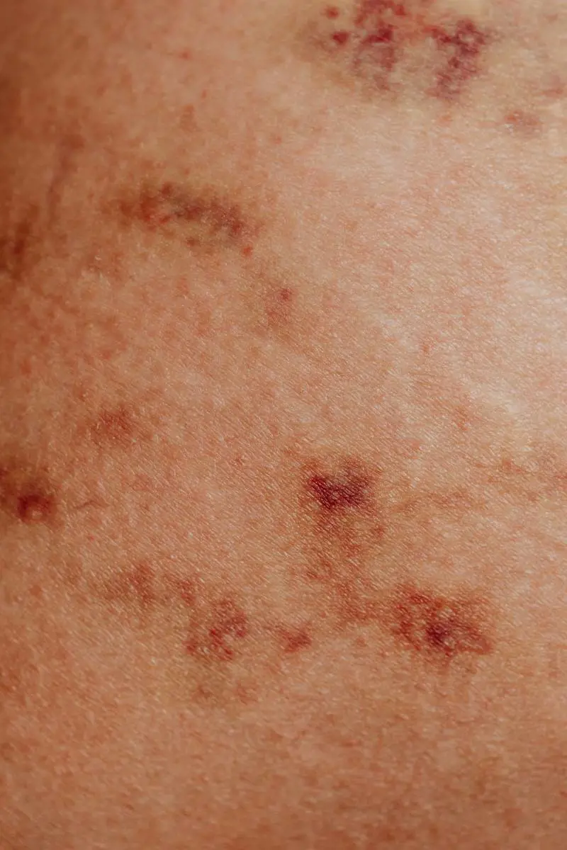 Macchie rosse sulla pelle: cause, rimedi e cure