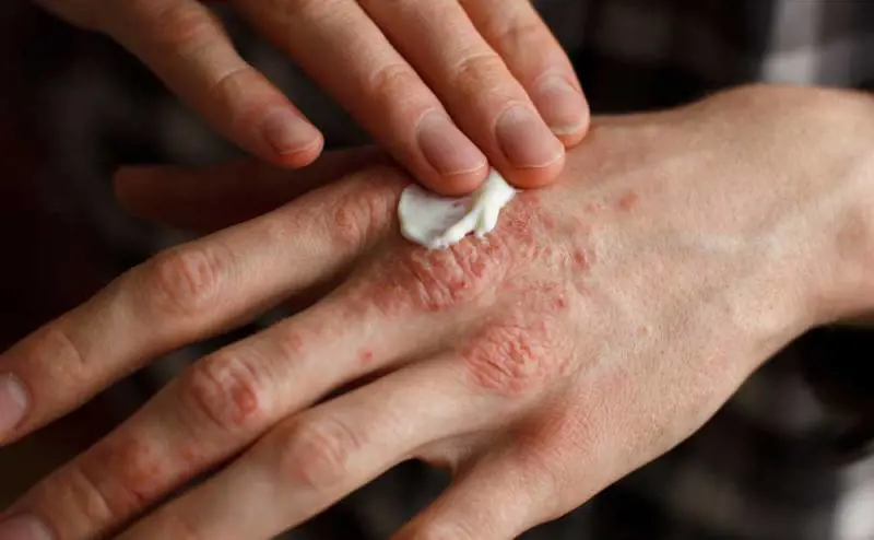 Focus su psoriasi e dermatite seborroica