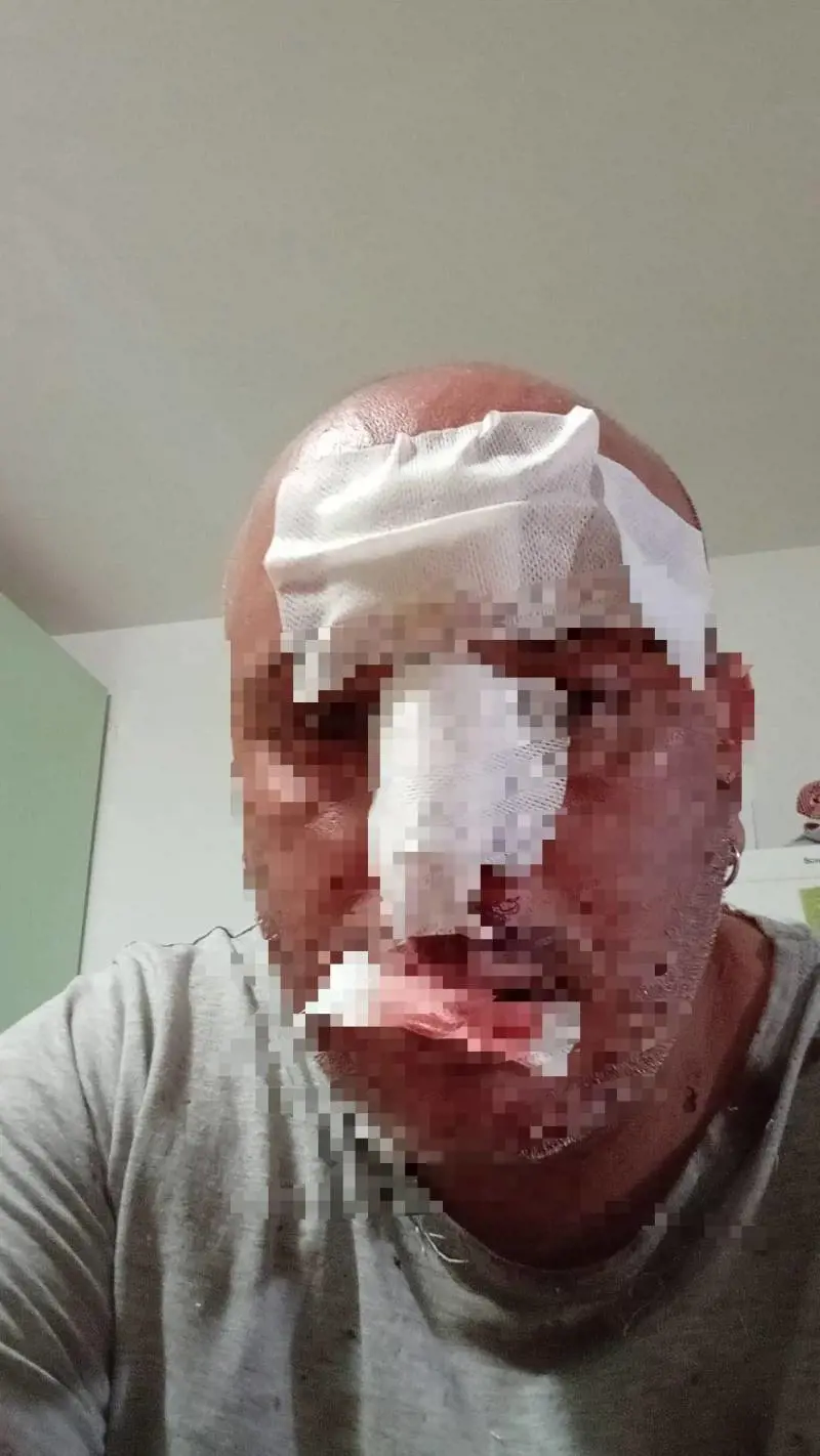 Pestato a sangue da tre stranieri mentre passeggia: l'orrore a Latina