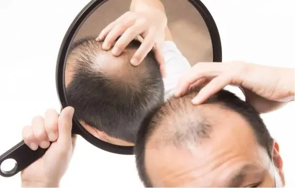 Caduta dei capelli nell'uomo: le cause e i rimedi