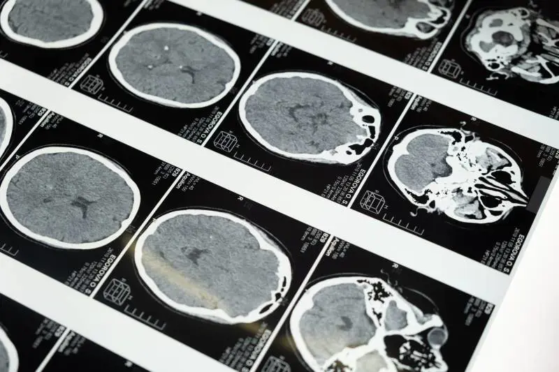 Estratto verme vivo dal cervello di una donna: primo caso al mondo