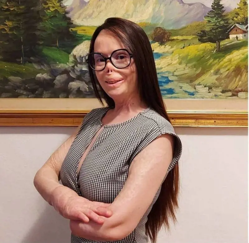 Valentina Pitzalis: "Il mio ex mi ha dato fuoco, ma io non ho perso il sorriso"