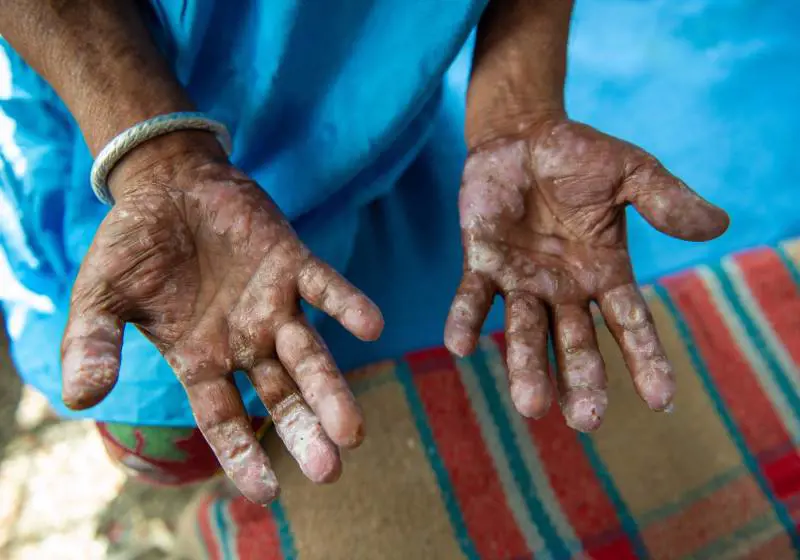 Torna la lebbra. Più infezioni anche negli Usa