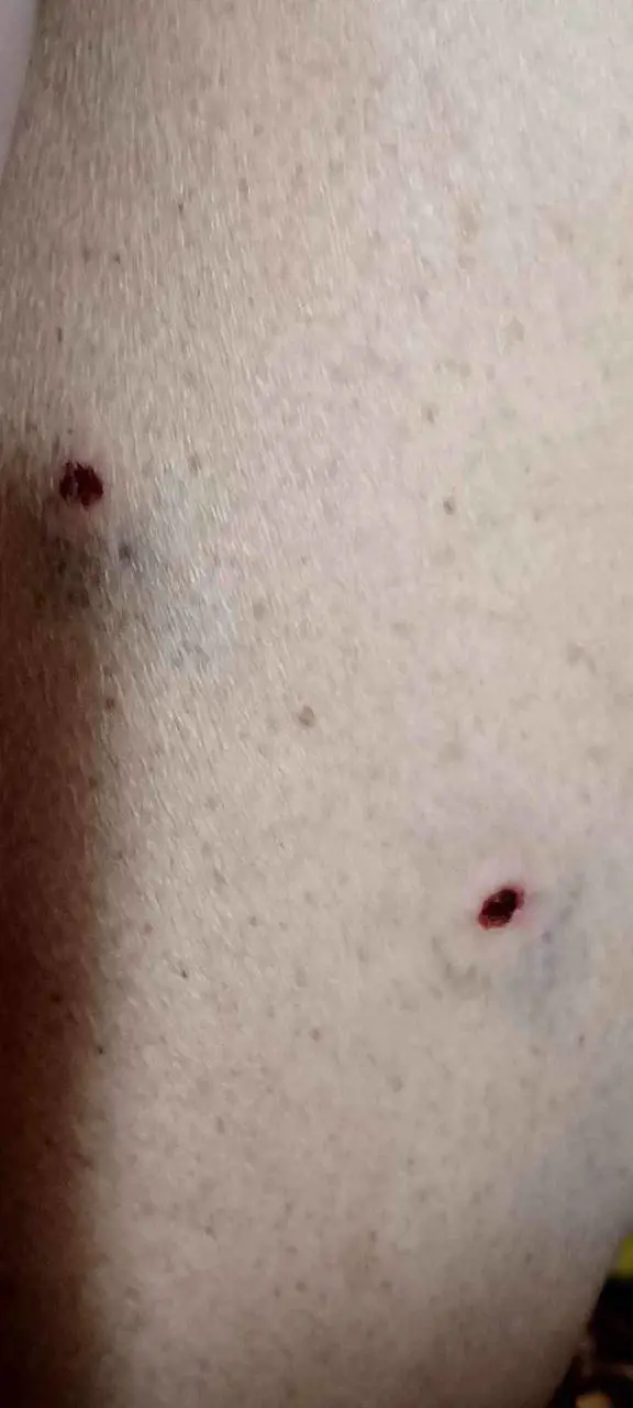 La gamba della compagna di Dudog dopo l'aggressione.