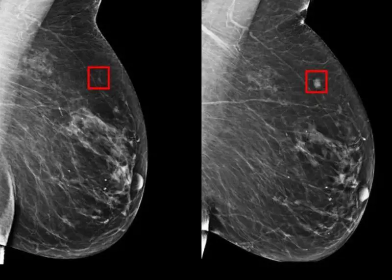 Rilevare il cancro al seno cinque anni prima: il test in tre ospedali