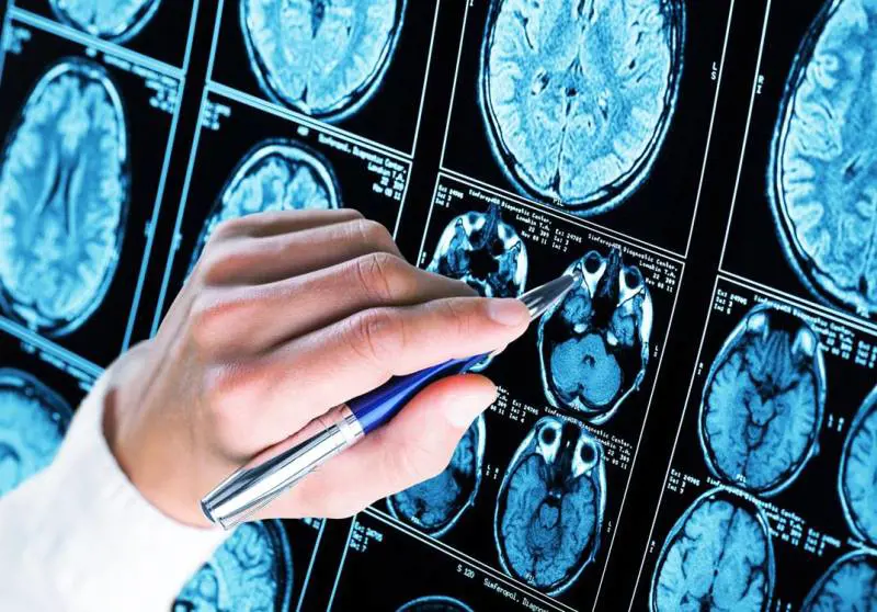 Alzheimer, una nuova terapia verso la cura della malattia