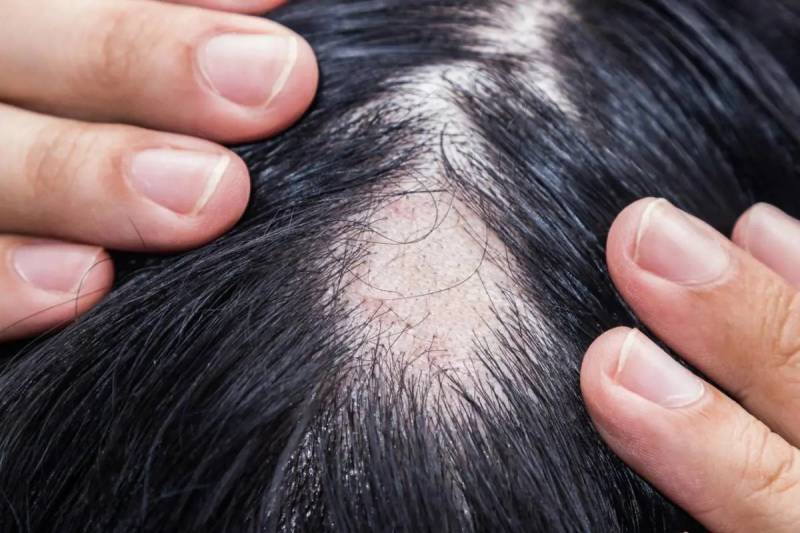 Alopecia, arriva la prima terapia orale per tutti: come funziona