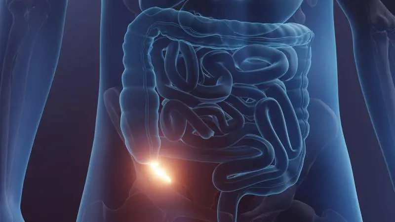 Cancro dell'appendice: cosa rivelano i nuovi studi