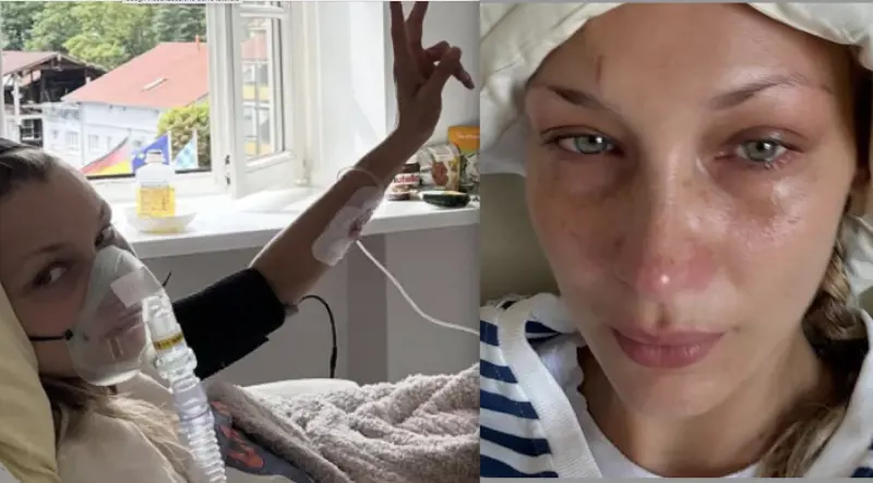 Bella Hadid in ospedale: preoccupano le sue condizioni a causa della malattia di Lyme
