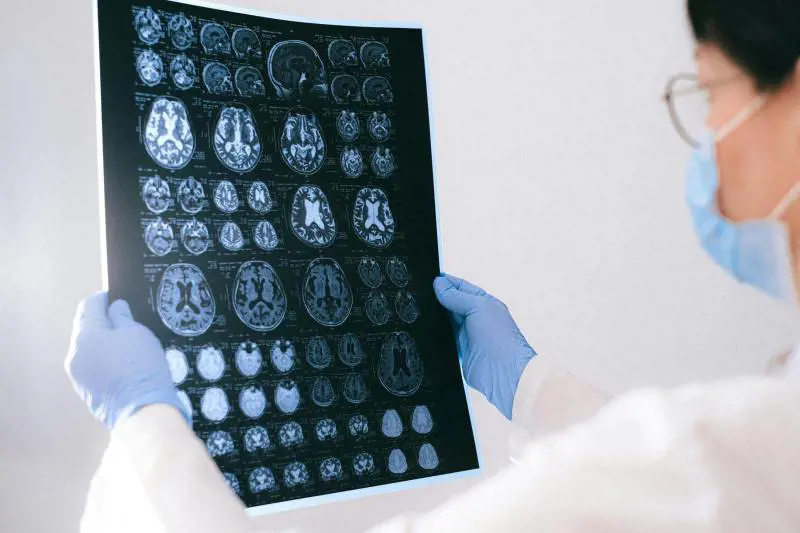 Cos'è l'amiloide, la proteina il cui accumulo eccessivo può portare all'Alzheimer