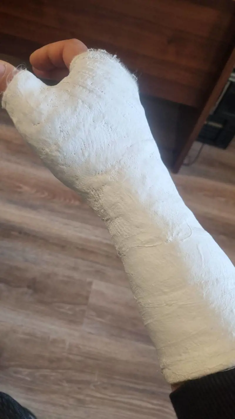 La mano ingessata dell'agente a seguito della colluttazione 