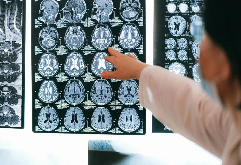 Ictus, la regola FAST e tutti i sintomi da non sottovalutare