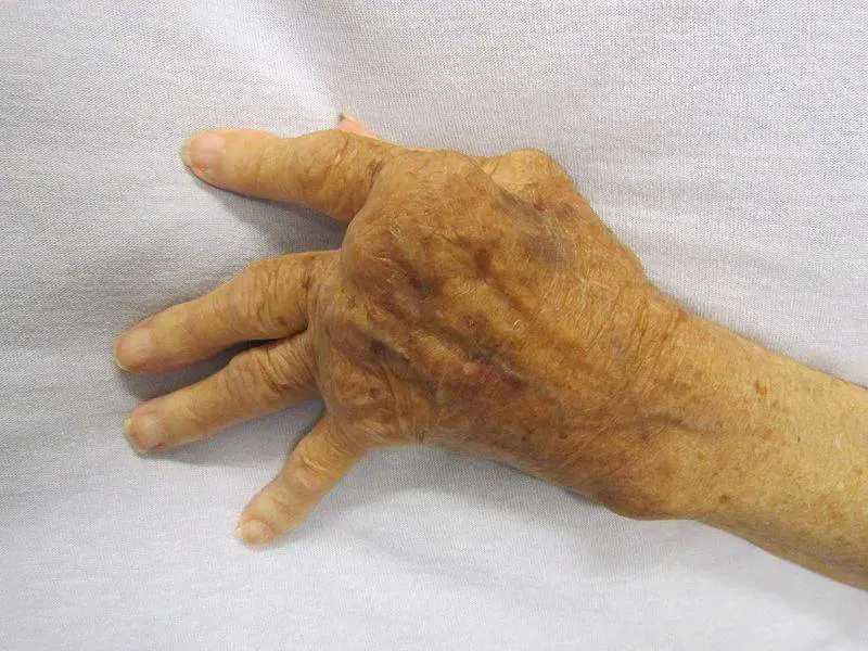 Artrite reumatoide, quali sono i sintomi?