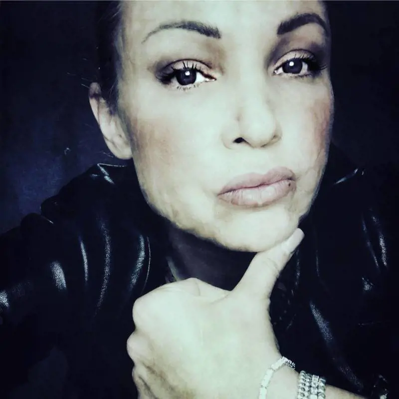 La storia dell'ex modella: "Sfigurata dal chirurgo estetico e senza riscarcimento"