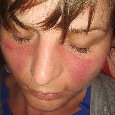 Lupus eritematoso sistemico, quali sono i sintomi?