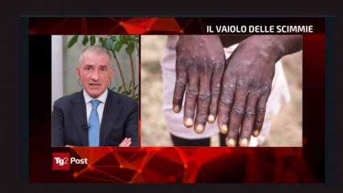 Vaiolo, “niente caccia all’untore”. Ma con i no vax si poteva fare