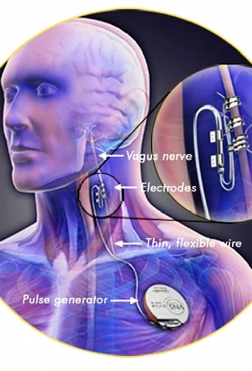 Impiantato il pacemaker anti-depressione