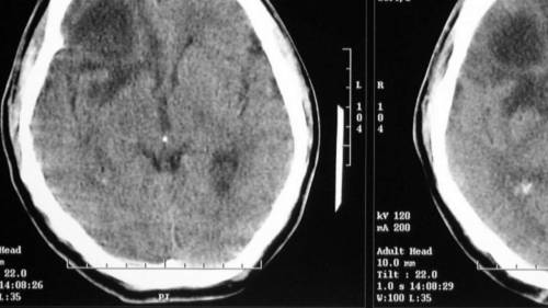 Scienza, ecco come il cervello 
trasforma i destri in mancini