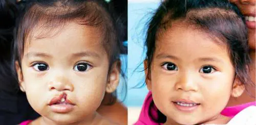 Operation Smile: quegli angeli italiani che ridisegnano il sorriso ai bambini