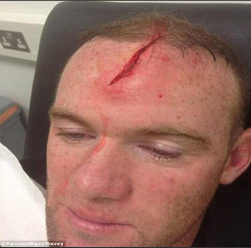 Rooney, le foto dell'infortunio e la satira sul web
