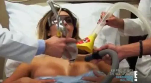 Kim Kardashian, laser sul seno per rimuovere le smagliature