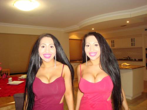 Australia, chirurgo rende perfettamente identiche due gemelle