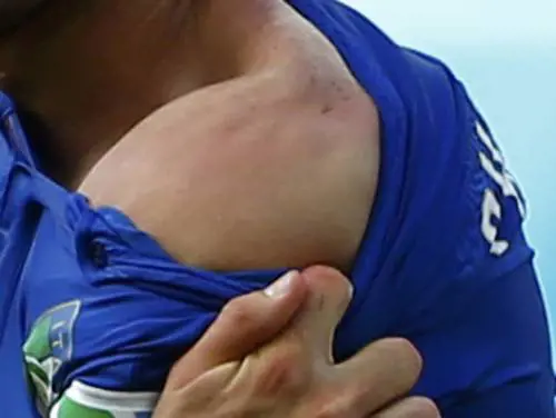 Il morso, o presunto tale, denunciato da Chiellini