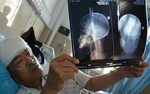 Gli si conficca un coltello in testa, ma lui non se ne accorge