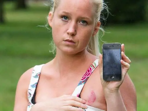 Si addormenta sopra l'iPhone, si sveglia con il seno ustionato